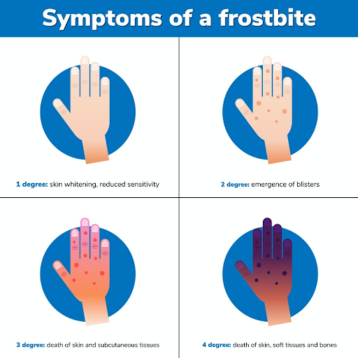 Frostbite Symptoms